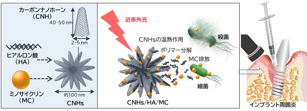 【名城大学・北海道大学】インプラント周囲炎に対する光応答性ナノ複合体を開発