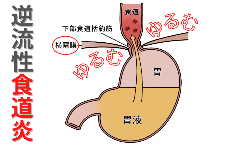 逆流性食道炎を引き起こす3つ原因を解説｜堺市いたわり健康院 さかい快福整体堂