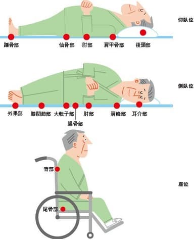 褥瘡の好発部位