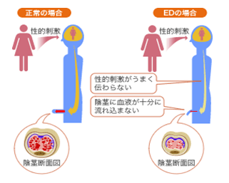 ED治療の現状