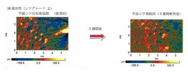 図4：皮膚用非接触3D測定システムによる平面シワ分布の高低図比較