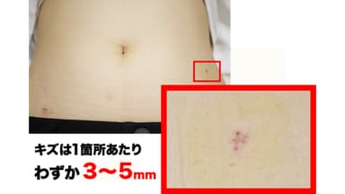 腹腔鏡手術による小さいキズ(5ミリ以下で可能です)