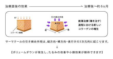 サーマクールのメカニズム