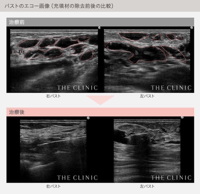 ジェル状充填剤を用いた豊胸術による相次ぐ失敗から
女性を救う専用窓口を開設