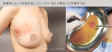 充填剤によって炎症を起こしたバストと、除去した充填剤