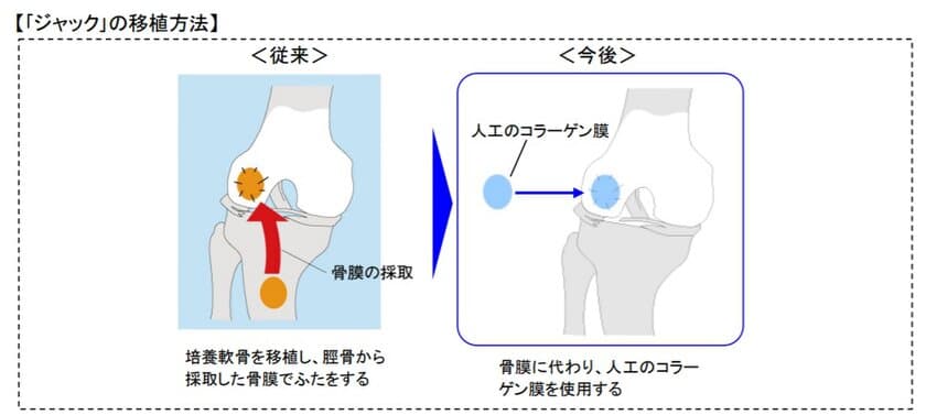 患者の身体的負担の軽減と医師の移植手技の簡便化を実現　
再生医療製品「自家培養軟骨ジャック(R)」の一部変更承認を取得 