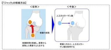 「自家培養軟骨ジャック(R)」の一部変更承認を取得