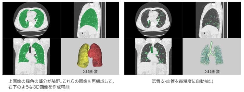 富士フイルムと京都大学　
AI技術を用いた間質性肺炎（*1）の診断支援技術の共同開発に成功