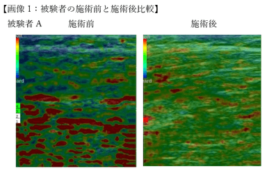 超音波エコー機器「エラストグラフィー」でも筋弛緩効果が認められています(固い筋肉＝青&#44;バランスの良い筋肉＝緑&#44;弱化した筋肉＝赤)