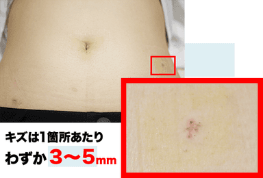 腹腔鏡手術による小さいキズ(5ミリ以下で可能です)