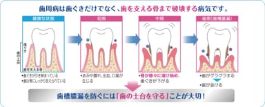 デントヘルス「歯の土台」画像