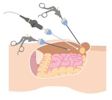 日帰り腹腔鏡手術4：炭酸ガスで腹腔内にスペースを設けて操作を行う