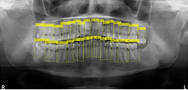 歯牙の自動認識結果