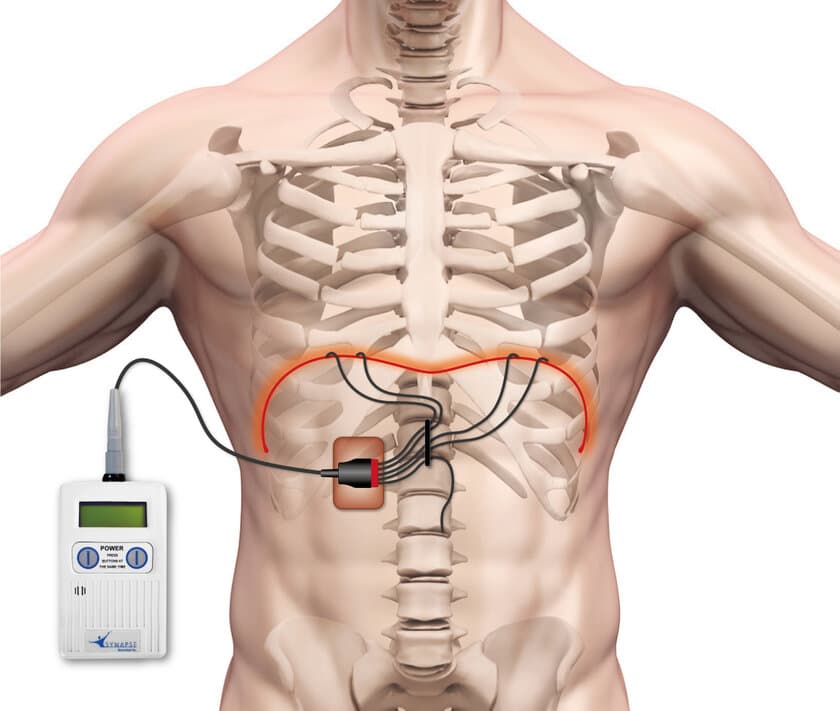 国内承認後初、体外式横隔膜ペースメーカー植込み成功