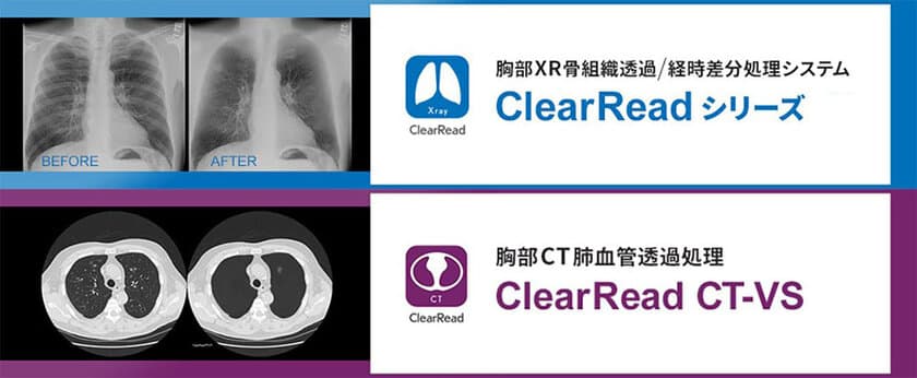 肺がんの早期発見を補助する先端読影支援システム　
胸部読影支援システム「ClearReadシリーズ」
導入100施設を突破