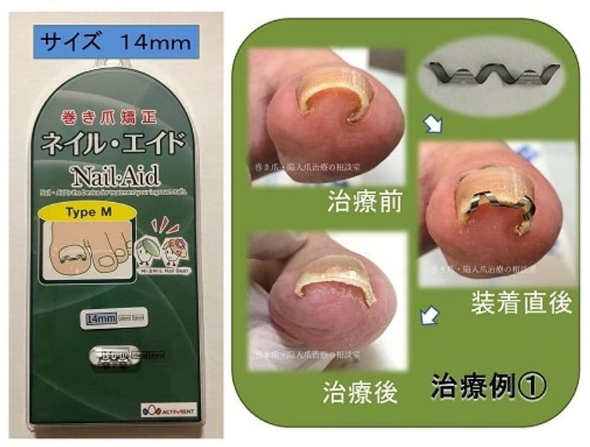 専門医師が開発した巻き爪矯正器具「ネイルエイド」で
2万人以上の「巻き爪難民」を救済！　
～10人に1人が悩んでいる「巻き爪」、治療費は自費負担で高額～