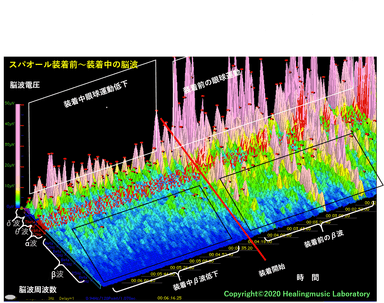 スパオール製品装着前後の脳波の状態