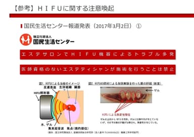 HIFUに関する注意喚起