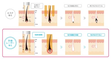 医療脱毛とエステ脱毛