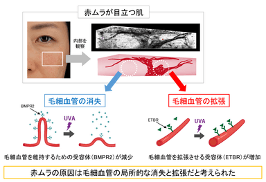 図4　肌に赤ムラが生じるメカニズム