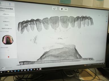 入れ歯の形状をデータ処理中