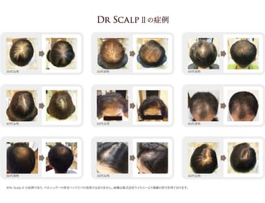 Dr Scalp IIの症例