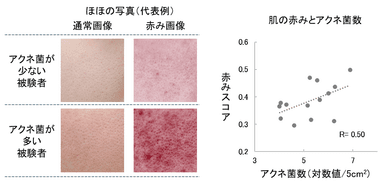 肌の赤みとアクネ菌数との関係