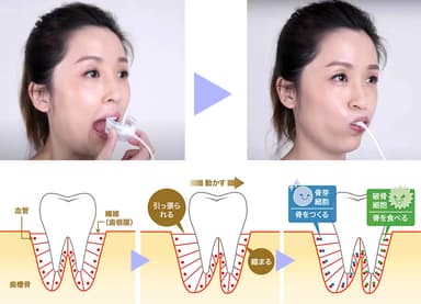 「光加速矯正装置(ヒーリング)」の歯の動く仕組み