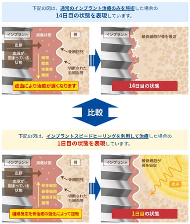 インプラントスピードヒーリングを利用した場合の比較