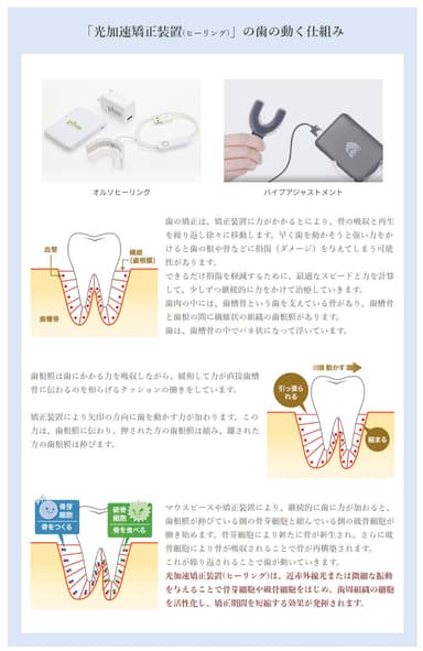 「光加速矯正装置(オルソヒーリング)」の歯の動く仕組み