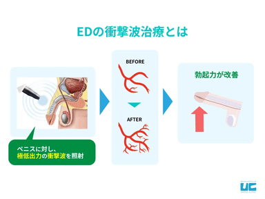 EDの衝撃波治療とは