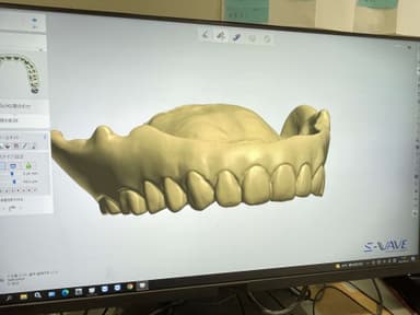 入れ歯データが3Dに変換