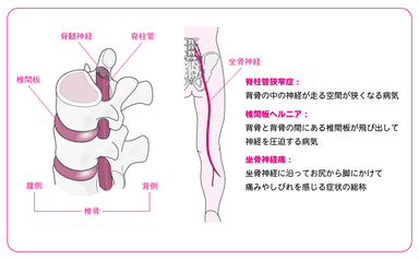 痛みやしびれを伴う代表的な疾患