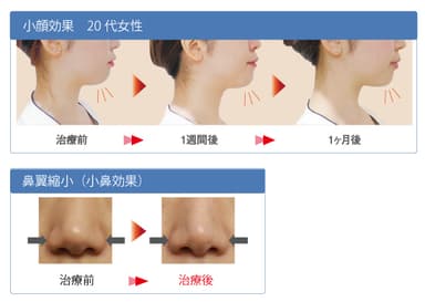 図7：症例写真「小顔効果」＆「鼻翼縮小(小鼻効果)」