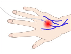 ハンドベイン治療のイメージ図