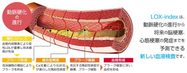 LOX-index(R)と動脈硬化の進展