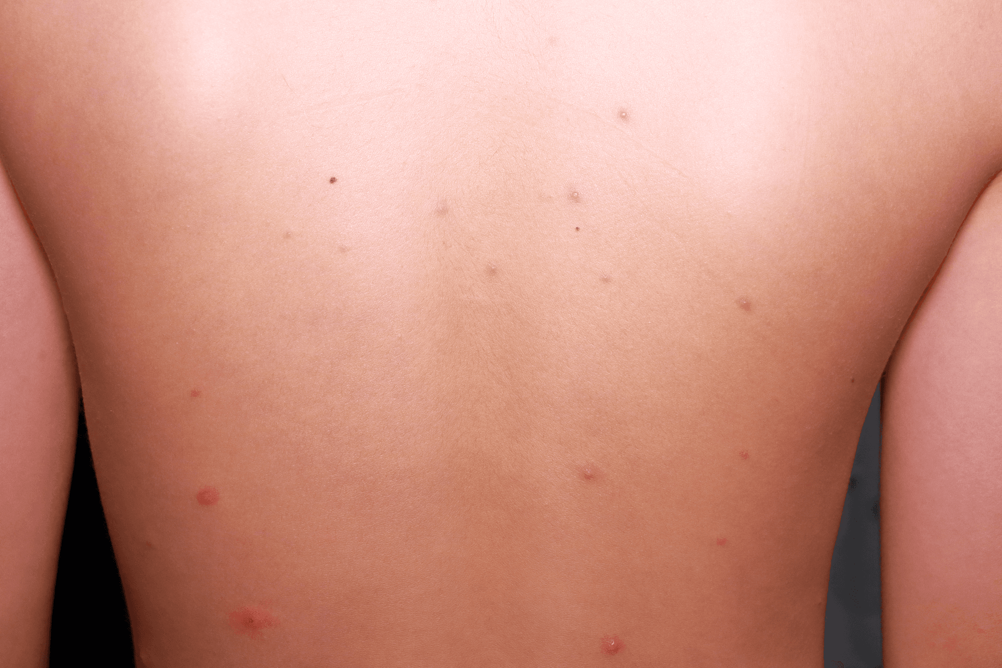 大正健康ナビ、10/29新着情報  かゆみを伴う水ぶくれの発疹ができる感染症 「水ぼうそう(水痘)」 を公開!