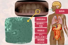 歯垢と全身疾患の相関関係