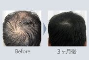 発毛効果について(2)