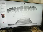 入れ歯の形状をデータ処理中