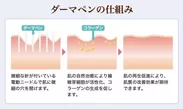 ダーマペン仕組み