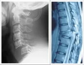 脊髄損傷の再生医療