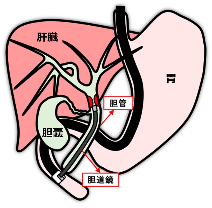 岡山大学病院と両備システムズ、
国内初となる胆道がんをAIで診断支援するシステムを開発