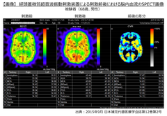 【画像】経頭蓋微弱超音波振動刺激装置による刺激前後における脳内血流のSPECT画像