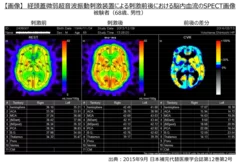 【画像】経頭蓋微弱超音波振動刺激装置による刺激前後における脳内血流のSPECT画像