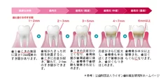 歯周病の進行